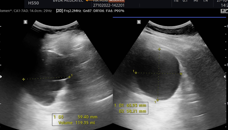 Hình ảnh nang thận trên siêu âm cho biết điều gì? 3