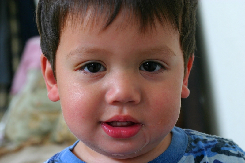 Hình ảnh sâu răng ở trẻ em và cách phòng ngừa sâu răng hiệu quả 1