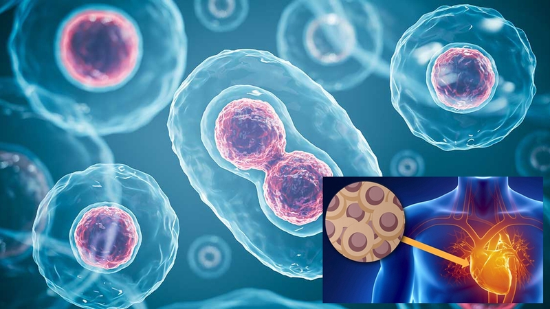 Hoại tử cơ tim do nhồi máu cơ tim là gì? Ứng dụng công nghệ tế bào gốc trong điều trị 4