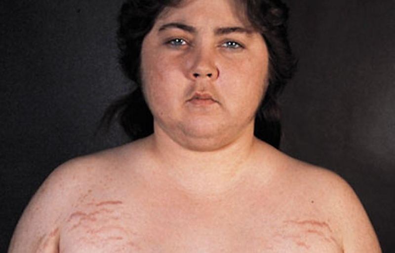 Hội chứng Cushing nên ăn gì? 1