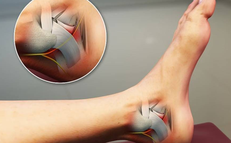 Hội chứng đường hầm cổ chân và những điều cần biết 1