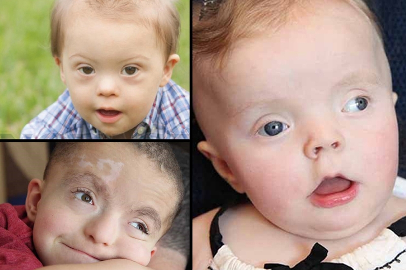 Hội chứng Pallister-Hall là gì? Có thể phòng ngừa được không? 1