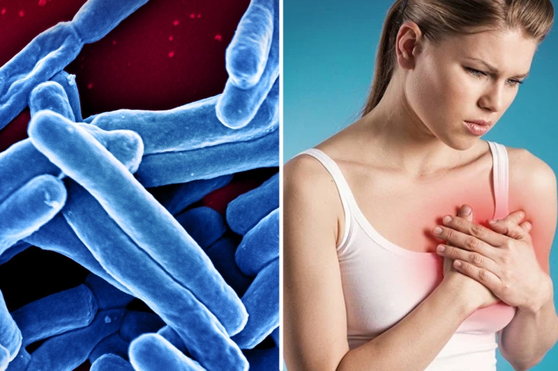 Lao vú có lây không? Cách phòng ngừa bệnh lao vú hiệu quả 1