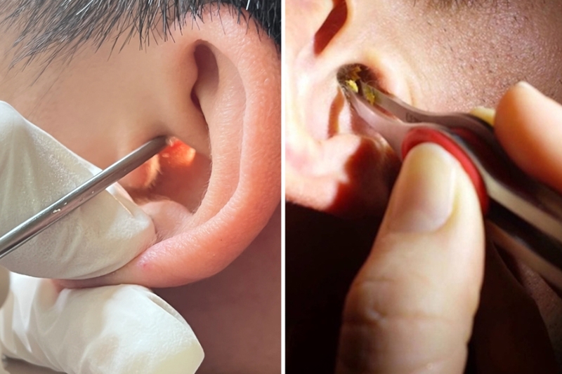 Lấy ráy tai nội soi có an toàn không? Những điều cần lưu ý sau khi lấy ráy tai nội soi 3