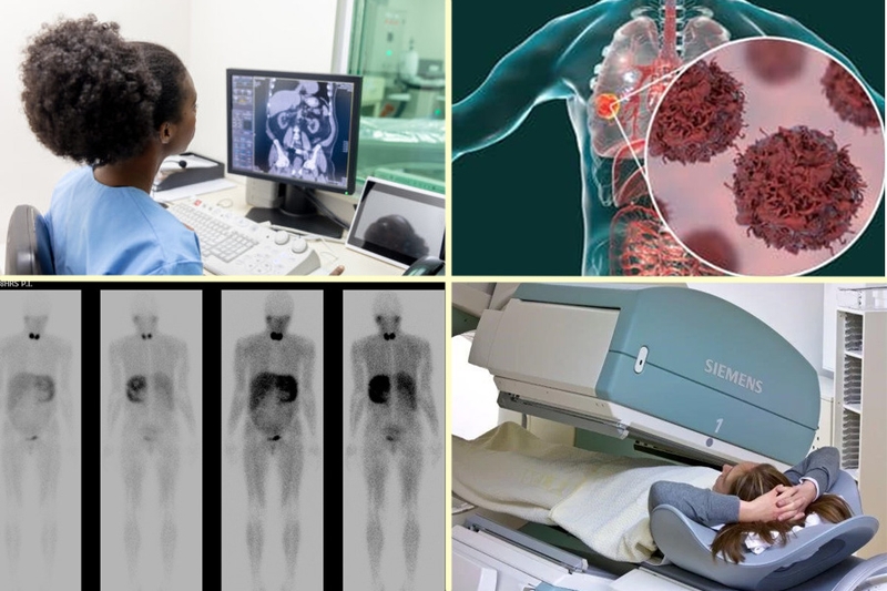 MIBG Scan là gì? Các bước thực hiện và tác dụng phụ cần lưu ý 1