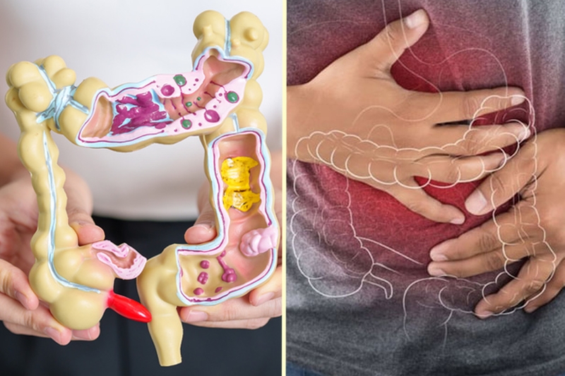 Mổ đại tràng​ và những biến chứng sau mổ cần lưu ý 1