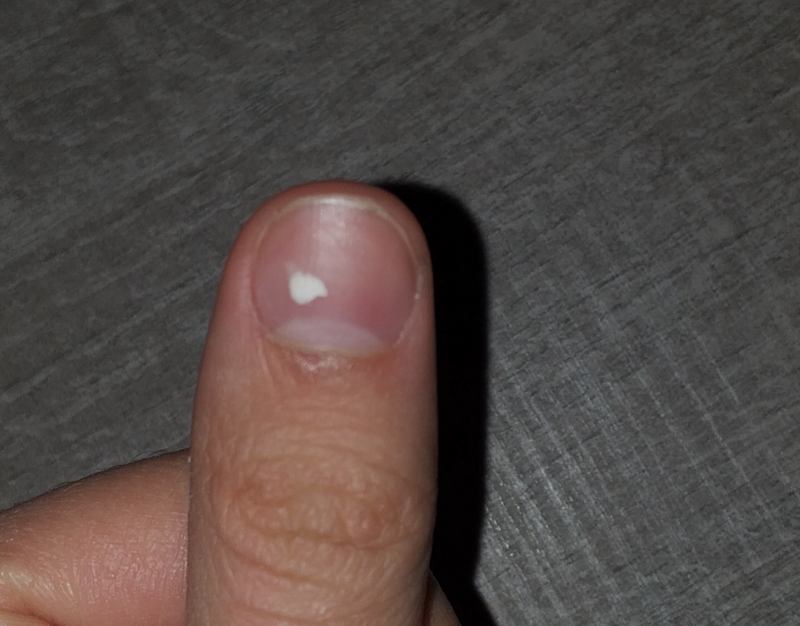 Móng tay trẻ có đốm trắng do nguyên nhân gì? Khi nào cần đi khám bác sĩ? 1