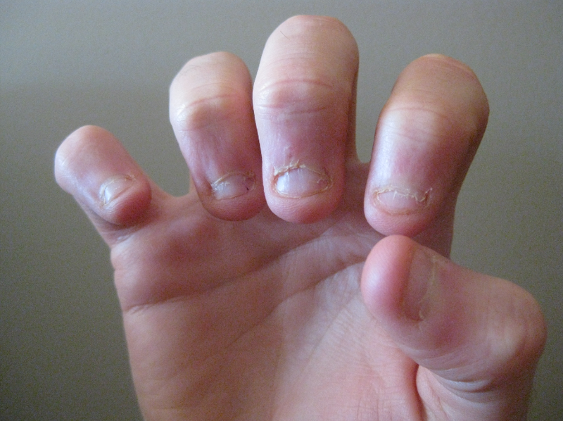 Móng tay trẻ có đốm trắng do nguyên nhân gì? Khi nào cần đi khám bác sĩ? 2