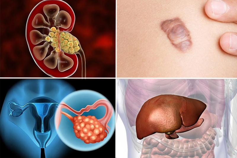 Nang là gì? Nguyên nhân gây u nang và phương pháp điều trị 1