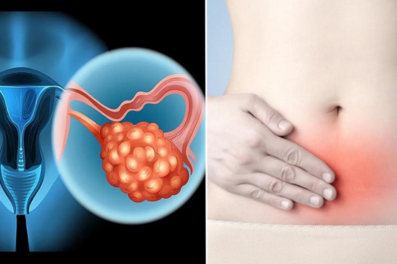 Nang là gì? Nguyên nhân gây u nang và phương pháp điều trị 2