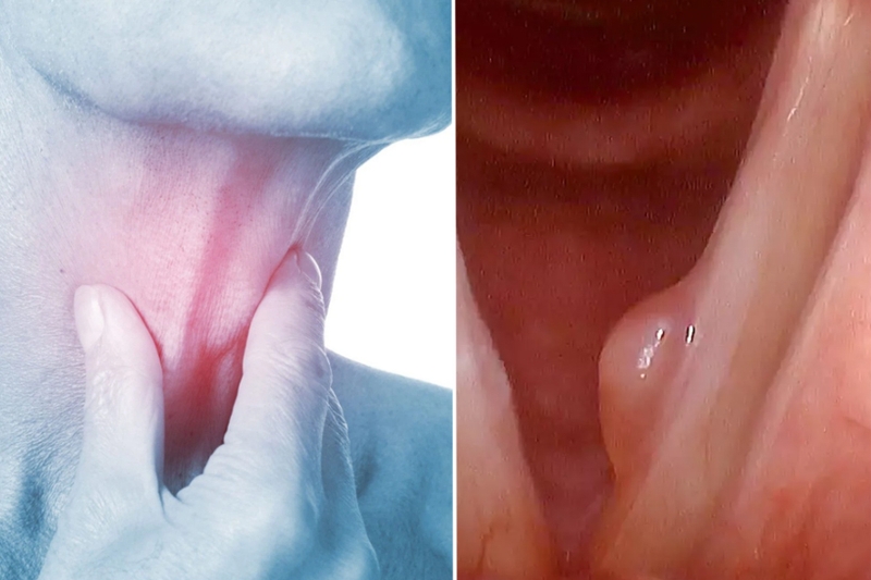 Nang là gì? Nguyên nhân gây u nang và phương pháp điều trị 3