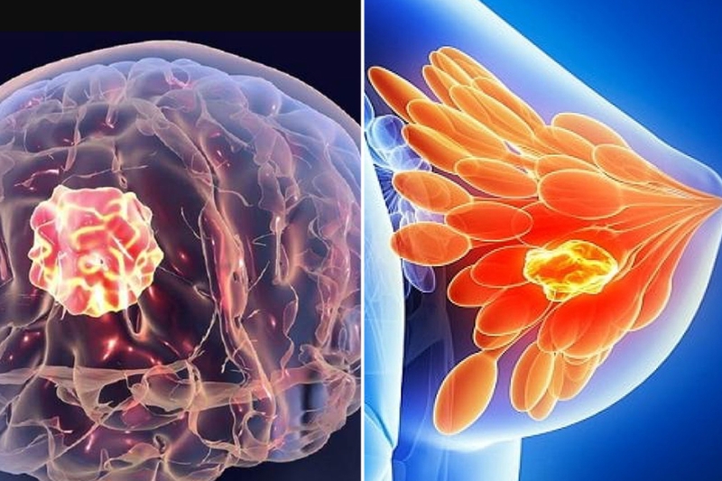 Nang là gì? Nguyên nhân gây u nang và phương pháp điều trị 4