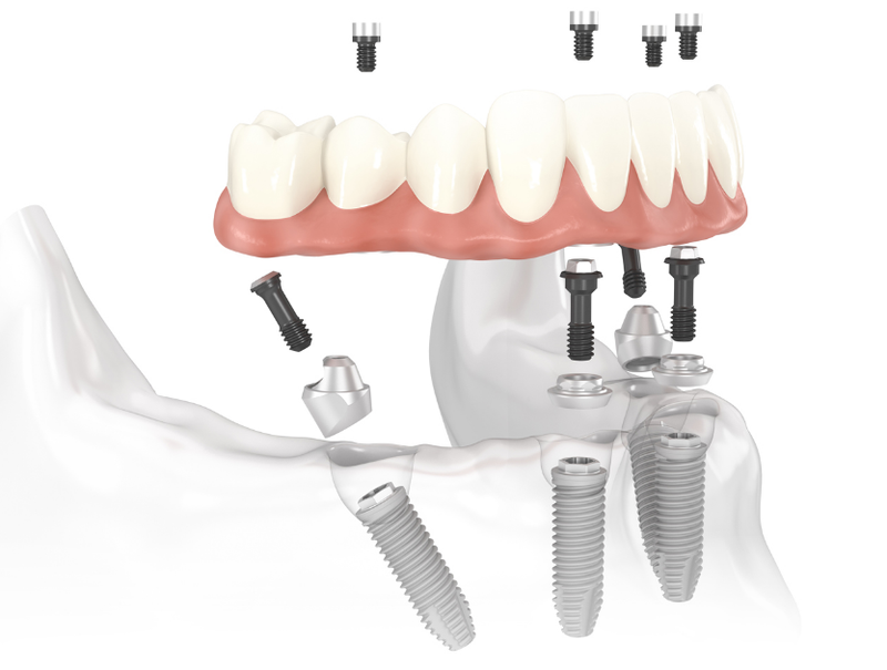 Người già có nên làm răng Implant không? Đâu là giải pháp thích hợp, an toàn? 4