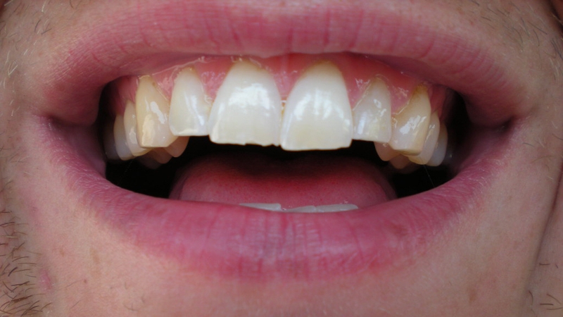 Nguyên nhân bị ê răng hàm trên và cách xử lý 3