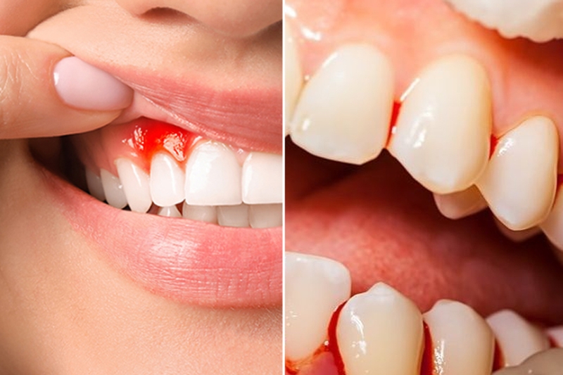 Nguyên nhân gây viêm lợi chảy máu chân răng và những yếu tố nguy cơ 1