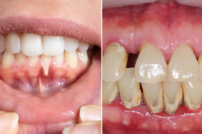 Nguyên nhân gây viêm lợi chảy máu chân răng và những yếu tố nguy cơ 4
