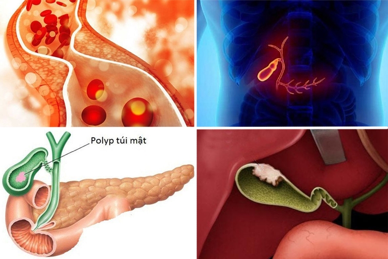 Nguyên nhân, triệu chứng và cách điều trị u túi mật lành tính 1