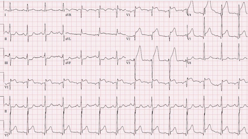 Nguyên nhân và cơ chế gây nhồi máu cơ tim? Cách ngăn ngừa, phòng bệnh hiệu quả 3