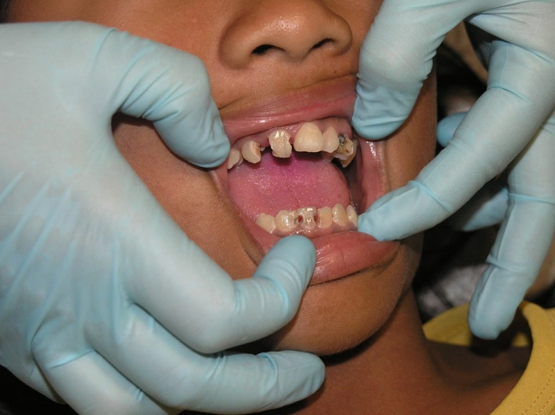 Nhai 1 bên bị lệch mặt làm sao khắc phục? 3