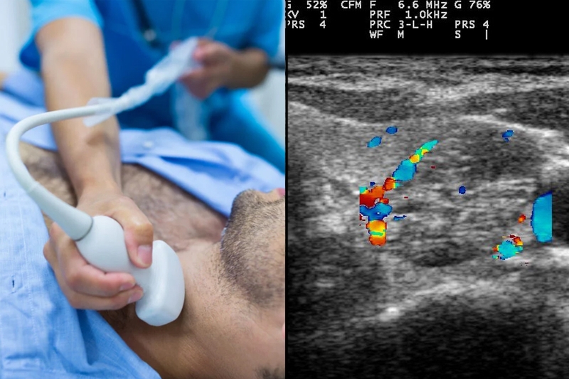 Nhân thùy phải tuyến giáp TIRADS 3 là bệnh gì? Các phương pháp điều trị hiệu quả 3