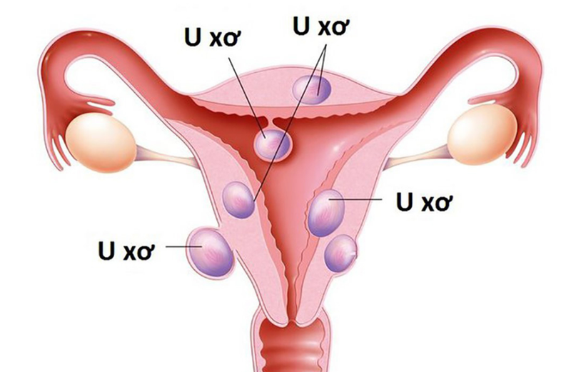 Nhân xơ tử cung khi mang thai có nguy hiểm không? 2