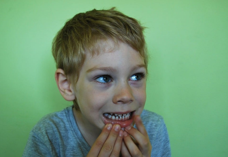 Nhổ răng lộ xương hàm do đâu? Những biến chứng có thể gặp phải khi nhổ răng 1