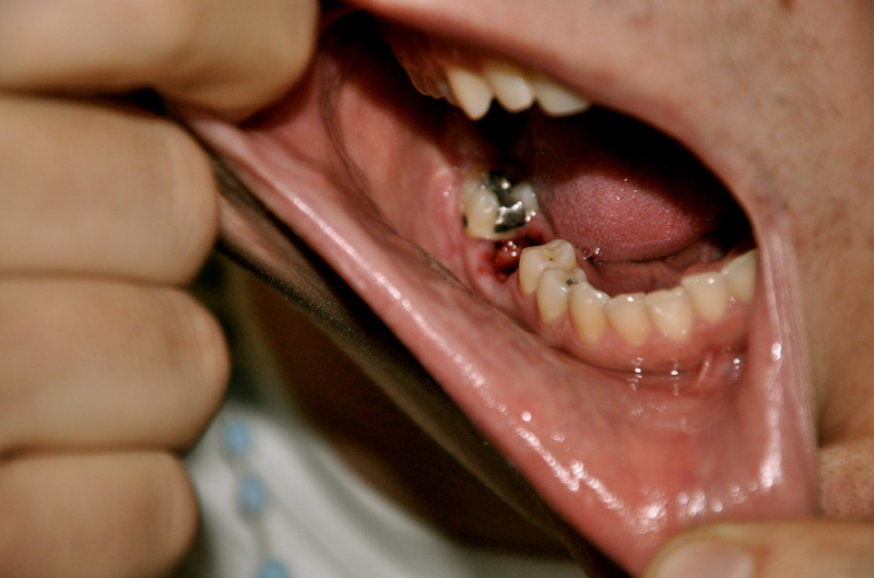 Nhổ răng lộ xương hàm do đâu? Những biến chứng có thể gặp phải khi nhổ răng 5