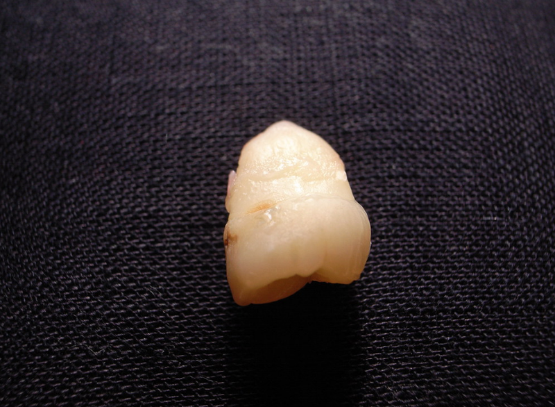 Những lưu ý khi niềng răng ai cũng cần biết 3