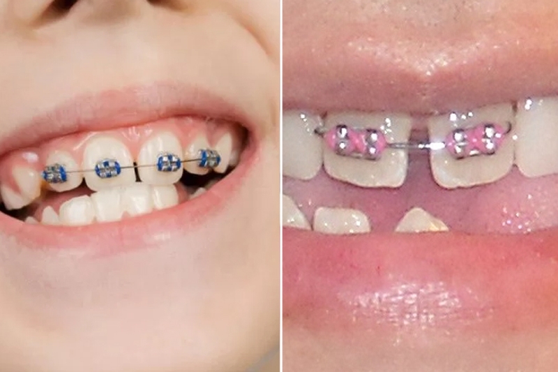 Niềng răng 1 cái có được không? Giải pháp khắc phục tình trạng 1 răng lệch 2