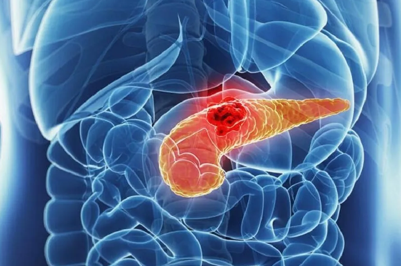 Nút mạch gan: Kỹ thuật điều trị ung thư gan hiệu quả 4