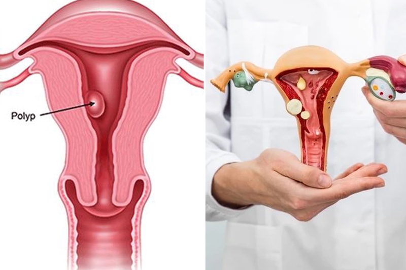 Phẫu thuật nội soi buồng tử cung là gì? Khi nào thực hiện? 2