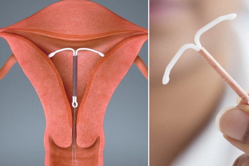 Phẫu thuật nội soi buồng tử cung là gì? Khi nào thực hiện? 3