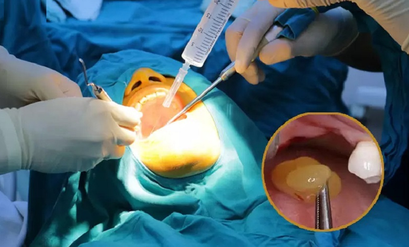 PRF: Phương pháp làm đẹp tự thân ứng dụng trong thẩm mỹ và nha khoa 4