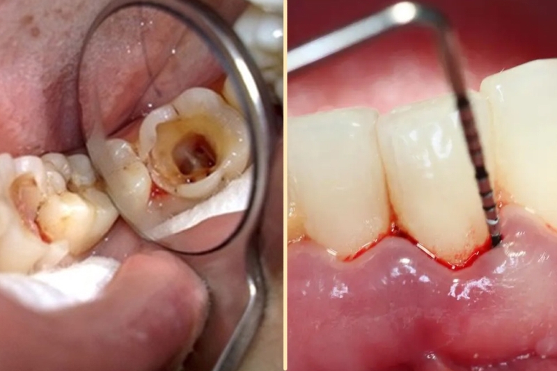 Răng sâu bị chảy máu do nguyên nhân gì? Cách xử lý và phòng ngừa 1