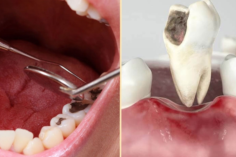 Răng sâu bị chảy máu do nguyên nhân gì? Cách xử lý và phòng ngừa 2