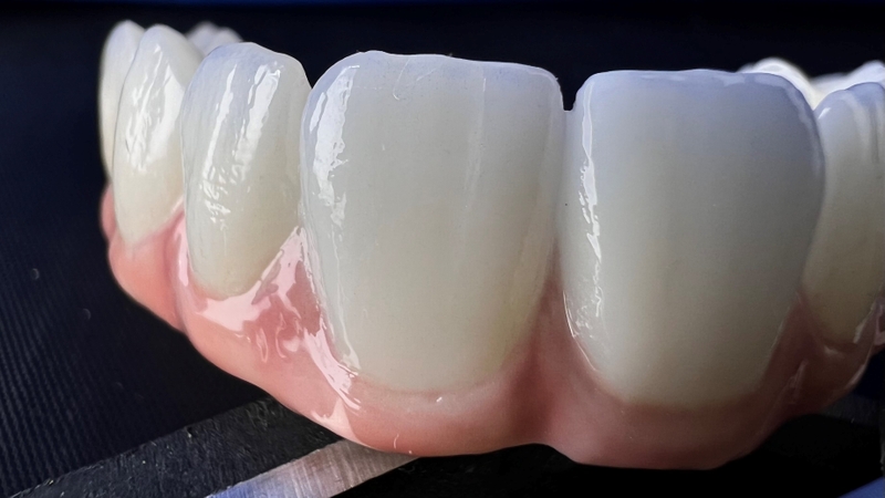 Răng sứ emax có mấy loại? Ưu, nhược điểm của từng loại 1