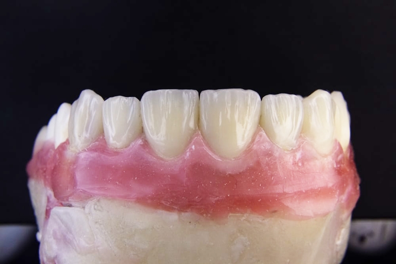 Răng sứ emax có mấy loại? Ưu, nhược điểm của từng loại 3