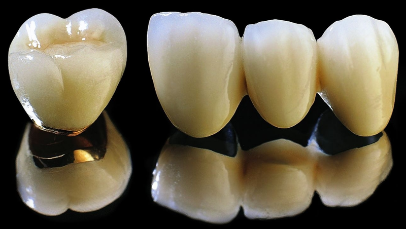 Răng sứ titan là gì? Ưu và nhược điểm của răng sứ titan 2
