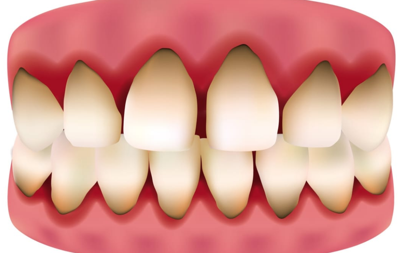 Răng sứ titan là gì? Ưu và nhược điểm của răng sứ titan 3