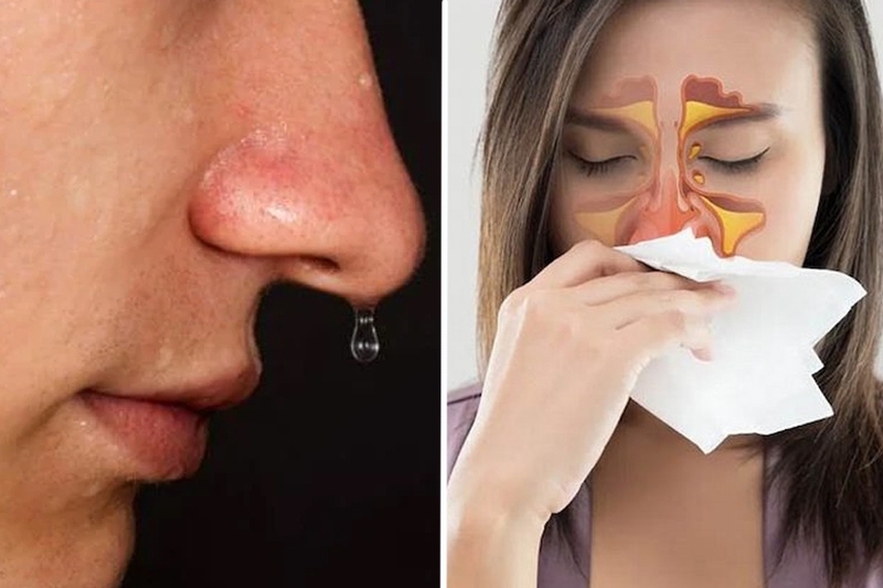 Rò dịch não tủy là gì? Có nguy hiểm không? 2