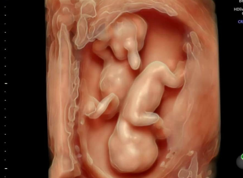 Siêu âm 5D khác gì 4D? Những câu hỏi thường gặp về siêu âm 5D 2