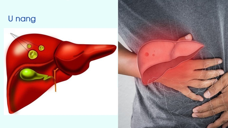 Siêu âm chọc hút nang gan là gì? Ai cần thực hiện? 1