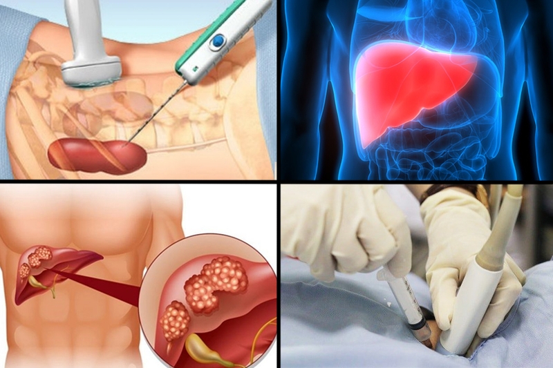 Siêu âm chọc hút nang gan là gì? Ai cần thực hiện? 2