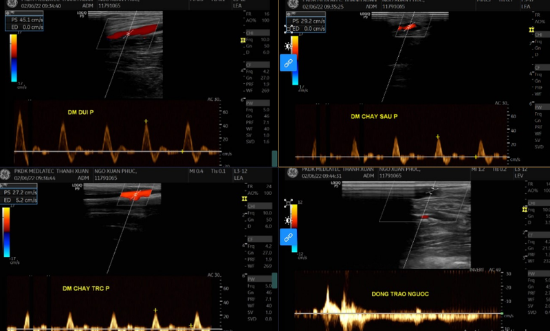Siêu âm Duplex là gì? Có thể phát hiện được những bệnh gì? 3