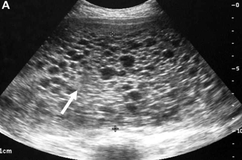 Siêu âm gan mật: Định nghĩa, khi nào cần siêu âm, chẩn đoán bệnh gì? 2