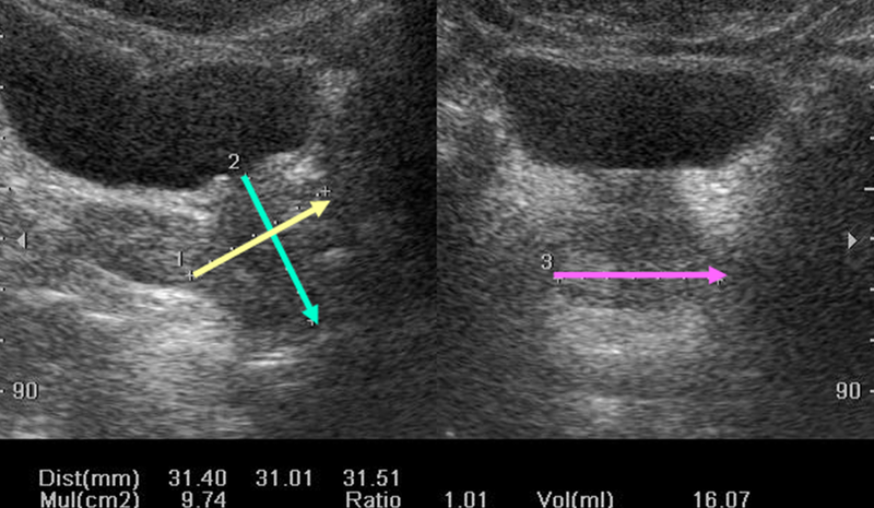 Siêu âm vùng chậu là gì? Phát hiện được những bệnh lý gì ở nam và nữ? 3