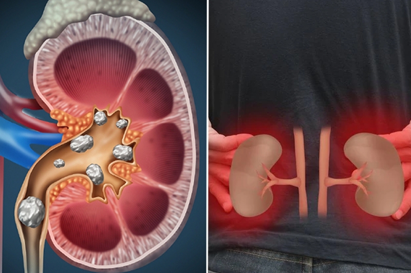Sỏi thận đài dưới là gì? Nguyên nhân, dấu hiệu nhận biết và cách điều trị, phòng ngừa 1
