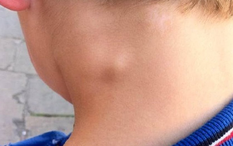 Sốt nóng lạnh nhức mỏi đau đầu là triệu chứng của bệnh gì? 2