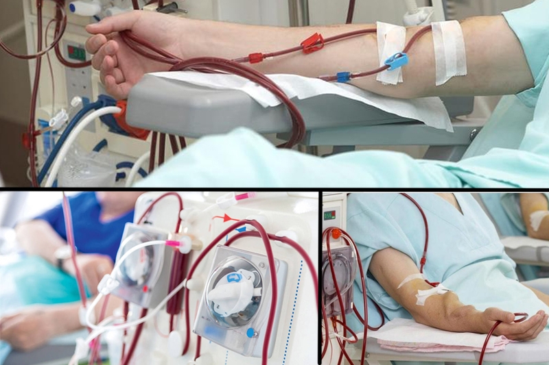 Suy thận cấp có phải chạy thận không? Các biến chứng và đối tượng nguy cơ gặp suy thận cấp 2