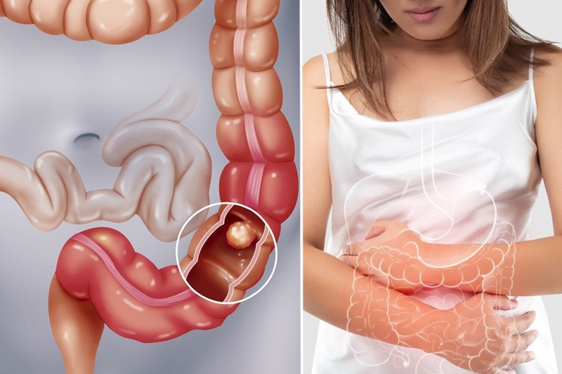 Tắc ruột do bã thức ăn là gì? Có nguy hiểm không? 1